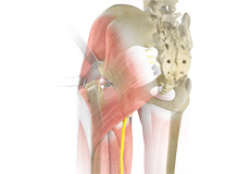 Complex Hip Replacement
