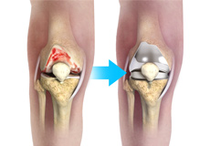 Complex Knee Replacement