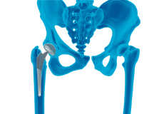 Correction of a Loose Hip Replacement
