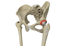 Correction of a Painful Hip Replacement