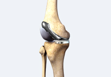 Custom Knee Replacement