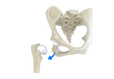 Hip Dislocation