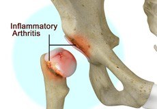 Inflammatory Arthritis of the Hip