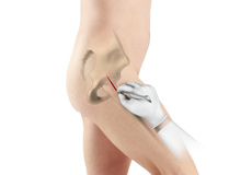Minimally Invasive Direct Anterior Hip Replacement