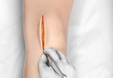 Minimally Invasive Knee Joint Replacement