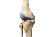 Partial Medial Knee Replacement