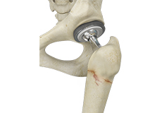 Periprosthetic Hip Fractures