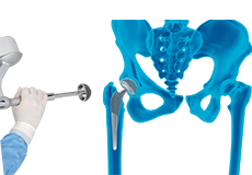 Robotic Total Hip Replacement