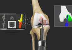 Robotic Unicondylar Knee Replacement