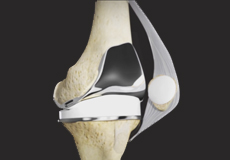 Tricompartmental Knee Replacement