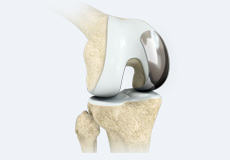 Unicondylar Knee Replacement